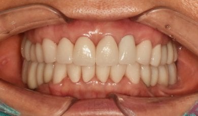 before-after photo dental-implant