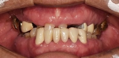 before-after photo dental-implant