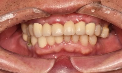 before-after photo dental-implant