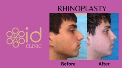 before-after photo rhinoplasty-nose-job
