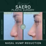 Результаты до и после удаления горбинки носа в SAERO Plastic Surgery, улучшенный профиль