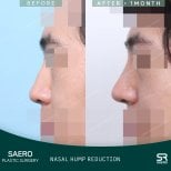 Before and after nasal hump removal results at SAERO Plastic Surgery, improved nose profile