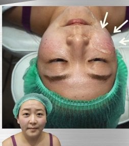 نتائج قبل وبعد علاج Ultherapy في عيادة DGB، شد ورفع بشرة الوجه