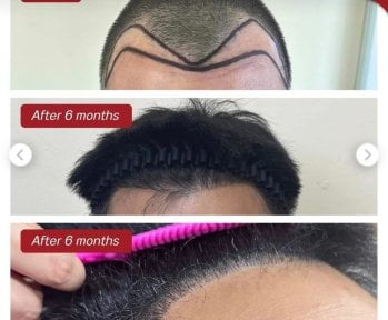 قبل وبعد زراعة الشعر FUE في عيادة DGB، استعادة خط الشعر بعد 6 أشهر