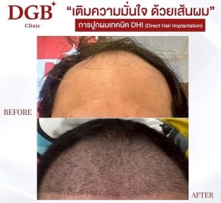 قبل وبعد زراعة الشعر بتقنية DHI في عيادة DGB – استعادة خط الشعر وامتلاء فروة الرأس
