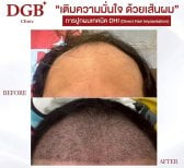 قبل وبعد زراعة الشعر بتقنية DHI في عيادة DGB – استعادة خط الشعر وامتلاء فروة الرأس
