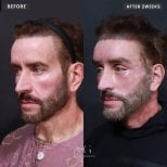 Resultados antes y después de deep plane facelift en VG Plastic Surgery, rejuvenecimiento facial