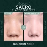 Before and after bulbous nose correction at SAERO Plastic Surgery, refined nose result