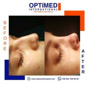 Résultat avant et après rhinoplastie chez Optimed International, forme du nez améliorée