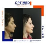 Résultat avant et après rhinoplastie chez Optimed International, profil du nez amélioré