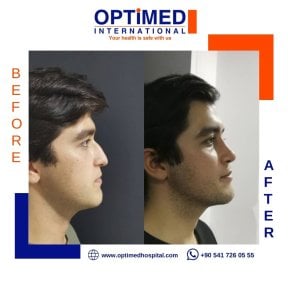 Résultats avant et après rhinoplastie chez Optimed International, profil du nez amélioré