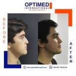 Résultats avant et après rhinoplastie chez Optimed International, profil du nez amélioré