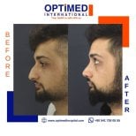 Résultat de rhinoplastie avant et après chez Optimed International, profil nasal amélioré chez l'homme