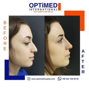 Résultats avant et après rhinoplastie chez Optimed International, remodelage du nez
