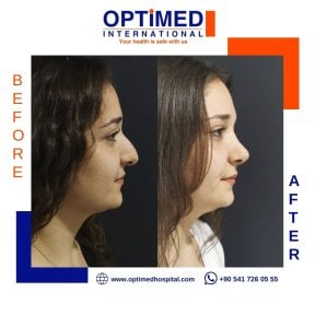 Résultats avant et après rhinoplastie chez Optimed International, profil du nez amélioré