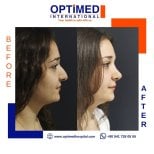 Résultats avant et après rhinoplastie chez Optimed International, profil du nez amélioré