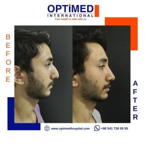 Résultats avant et après rhinoplastie chez Optimed International, profil du nez amélioré