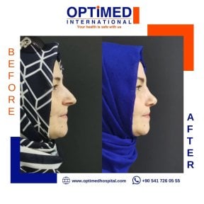 Résultats avant et après rhinoplastie chez Optimed International, profil du nez amélioré