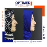 Résultats avant et après rhinoplastie chez Optimed International, profil du nez amélioré