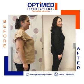 نتائج قبل وبعد تكميم المعدة في Optimed International – فقدان وزن ملحوظ