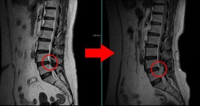 Before and after endoscopic discectomy results at Leadheal Hospital, improved spinal disc health
