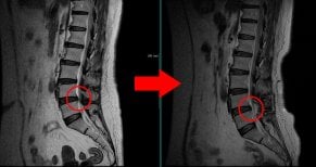Before and after endoscopic discectomy results at Leadheal Hospital, improved spinal disc health