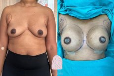 Before and after breast lift and augmentation results at Dr. MED clinic, improved contour