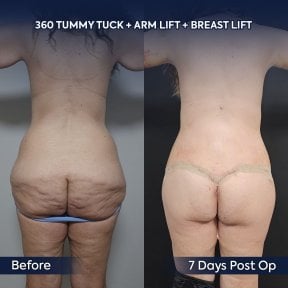 before-after photo arms-plastics-brachioplasty