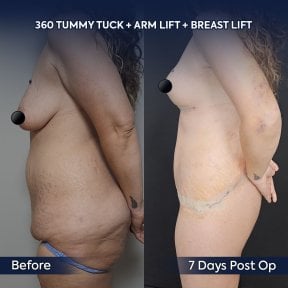 before-after photo arms-plastics-brachioplasty