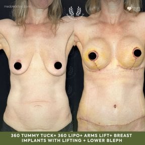 before-after photo arms-plastics-brachioplasty