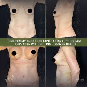 before-after photo arms-plastics-brachioplasty