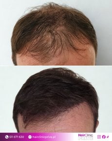 Before and after hair transplant results at HairClinic Prive – restored hairline and density