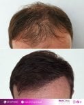 Before and after hair transplant results at HairClinic Prive – restored hairline and density
