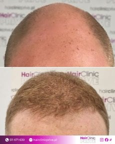 Before and after hair transplant results at HairClinic Prive – restored hairline and density