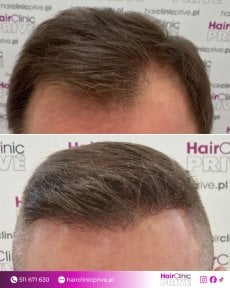 Before and after hair transplant result at HairClinic Prive – improved hairline density