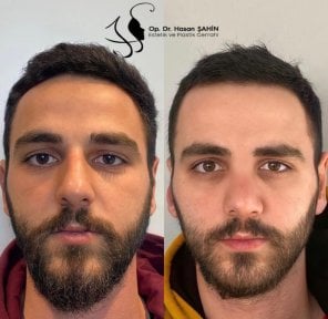 before-after photo tightening-of-facial-skin-facelift