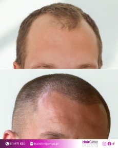 Before and after hair transplant result at HairClinic Prive – restored hairline in male patient