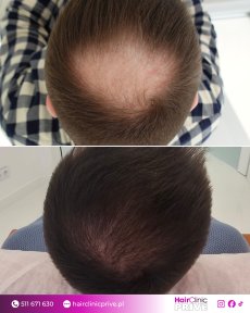 Before and after hair transplant result at Hair Clinic Prive – improved crown density