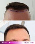 Before and after hair transplant results at Hair Clinic Prive – restored natural hairline