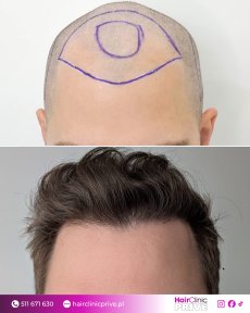 Before and after hair transplant result at Hair Clinic Prive – restored natural hairline