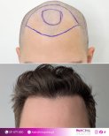Before and after hair transplant result at Hair Clinic Prive – restored natural hairline