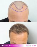Before and after hair transplant result at Hair Clinic Prive – restored natural hairline