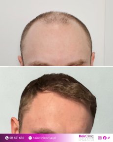 Before and after hair transplant result at HairClinic Prive – restored fuller hairline