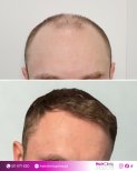 Before and after hair transplant result at HairClinic Prive – restored fuller hairline