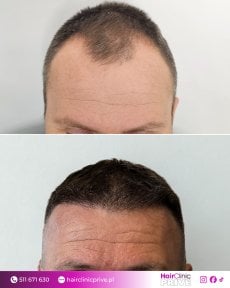 Before and after hair transplant results at HairClinic Prive – restored fuller hairline