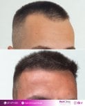 Before and after hair transplant results at HairClinic Prive – restored fuller hairline