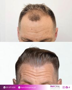 Before and after hair transplant result at Hair Clinic Prive – restored fuller hairline