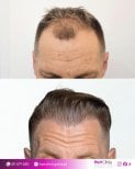 Before and after hair transplant result at Hair Clinic Prive – restored fuller hairline