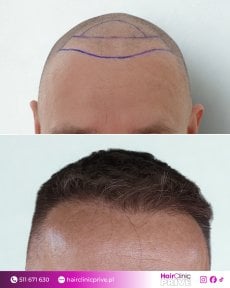 Before and after hair transplant results at Hair Clinic Prive – restored natural hairline