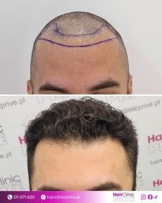 Before and after FUE hair transplant result at HairClinic Prive – restored hairline